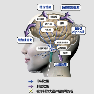 什么是CES（Cranial Electrotherapy Stimulation）经颅微电流刺激疗法